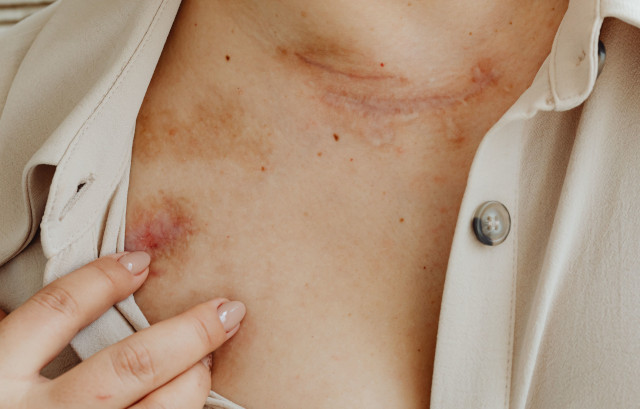 DermatologiaEstresse2_640